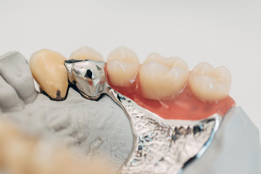 Zahnarzt-Prien-Niepmann-Leistungen-Implantologie-d